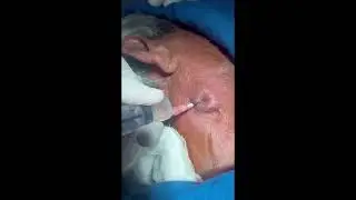 QUICK relief after PUS drainage || Small abscess BUT causing severe pain || Lymph node pus