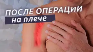 Операции на плече. Первые шаги к здоровому плечу.