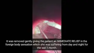 Immediate Relief after HUGE TONSIL STONE Removal || How to remove TONSIL STONE