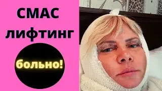 Блефаропластика и СМАС лифтинг. Личный опыт