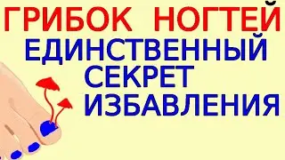 Как избавляться от ногтевого грибка правильно - самый Главный секрет. Демо сеанс ложного лечения