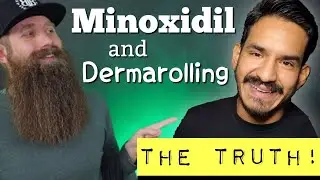 Minoxidil & Dermarolling - The TRUTH!