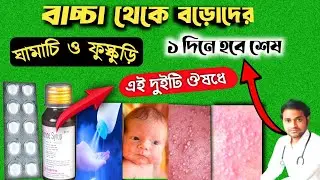 Baby prickly heat | Heat rash on baby | Heat rash | ঘামাচি পাউডার | ঘামাচির চিকিৎসা |