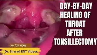 SEE REAL RESULTS: TIME-LAPSE of Healing After Tonsillectomy || Healing Day-by-Day From Day 0 - Day14