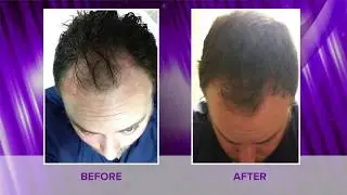 Platelet Rich Plasma (PRP) for Hair Loss | Spectrum Dermatology, Scottsdale, AZ