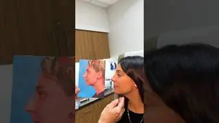 Amazing Rhinoplasty /Chin Augmentation Duo!-long-term results