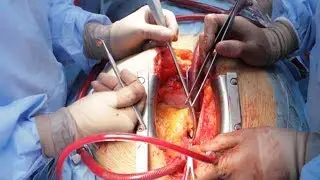 Inside Open Heart Surgery!  Fascinating Facts about the Human Heart, Attacks & Krill Oil Review!